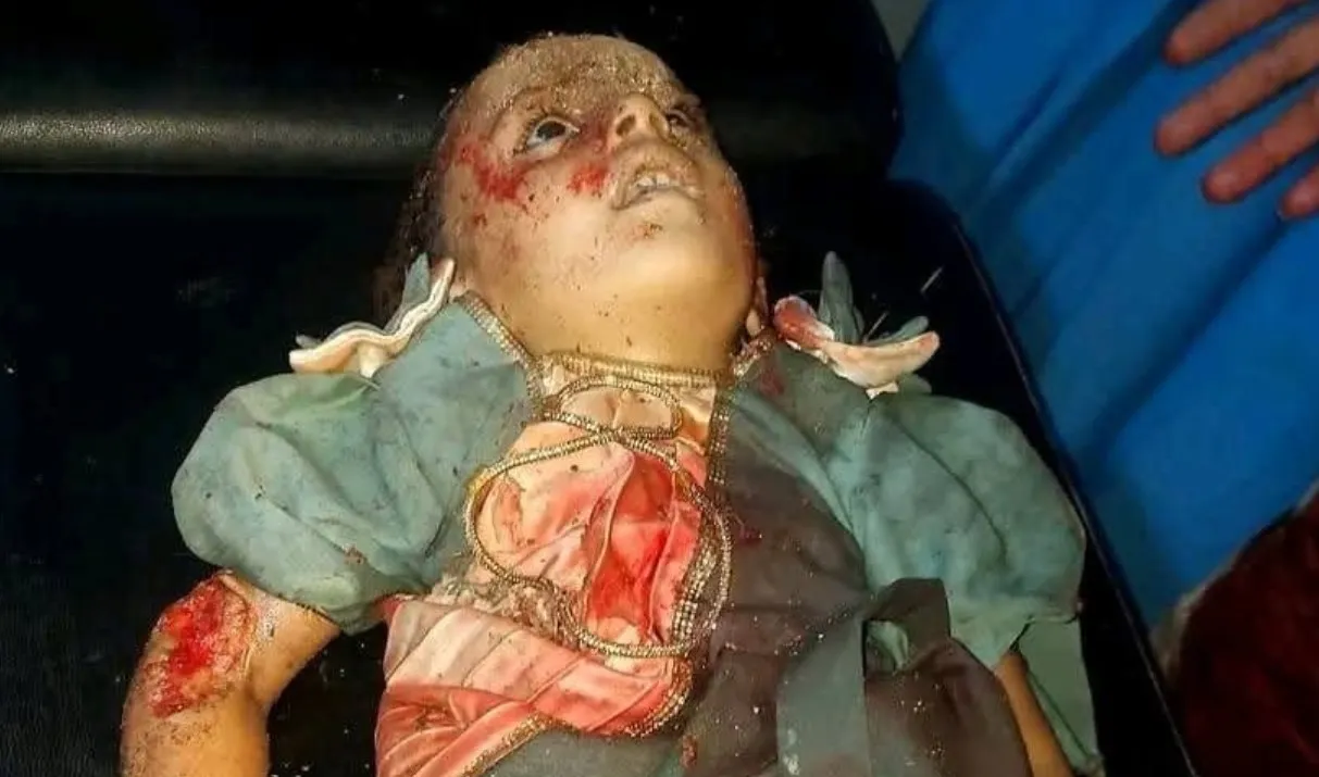 طفلة من ضحايا الجريمة الحوثية في حجة 